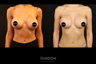 Breast Implant Exchange Before & After Gallery - Patient 588254 - Image 1