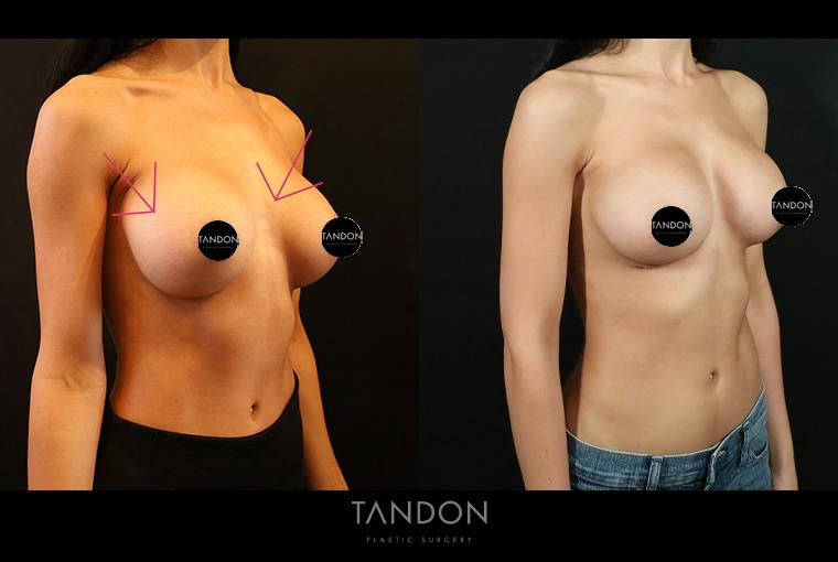 Breast Implant Exchange Before & After Gallery - Patient 588254 - Image 2
