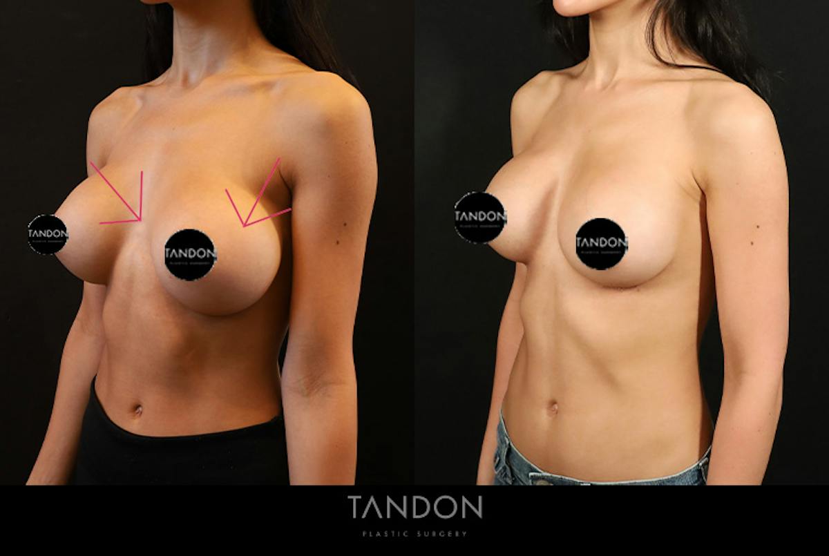 Breast Implant Exchange Before & After Gallery - Patient 588254 - Image 3