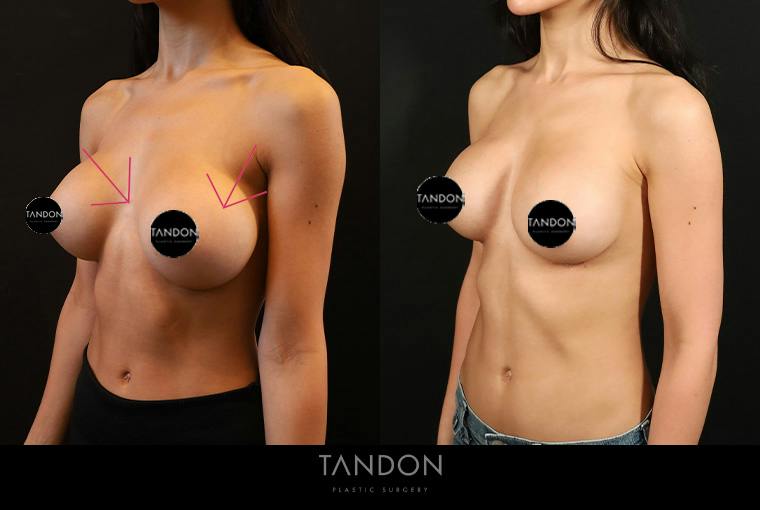Breast Implant Exchange Before & After Gallery - Patient 588254 - Image 3
