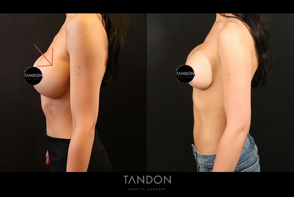 Breast Implant Exchange Before & After Gallery - Patient 588254 - Image 4