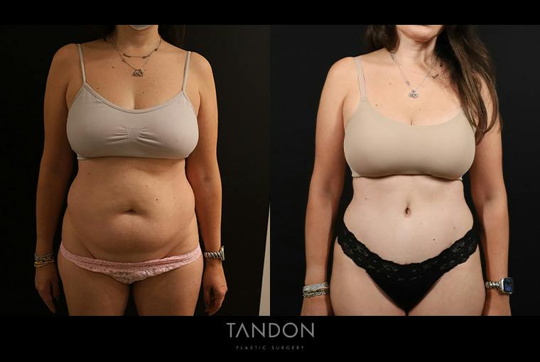 Liposuction and Fat Transfer Before & After Gallery - Patient 310712 - Image 1