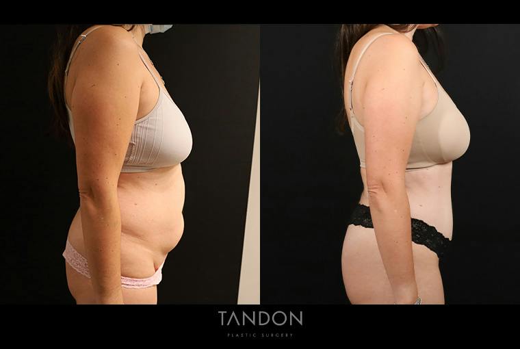 Liposuction and Fat Transfer Before & After Gallery - Patient 310712 - Image 3