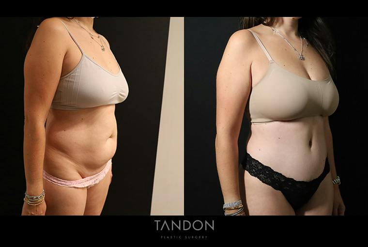Liposuction and Fat Transfer Before & After Gallery - Patient 310712 - Image 2