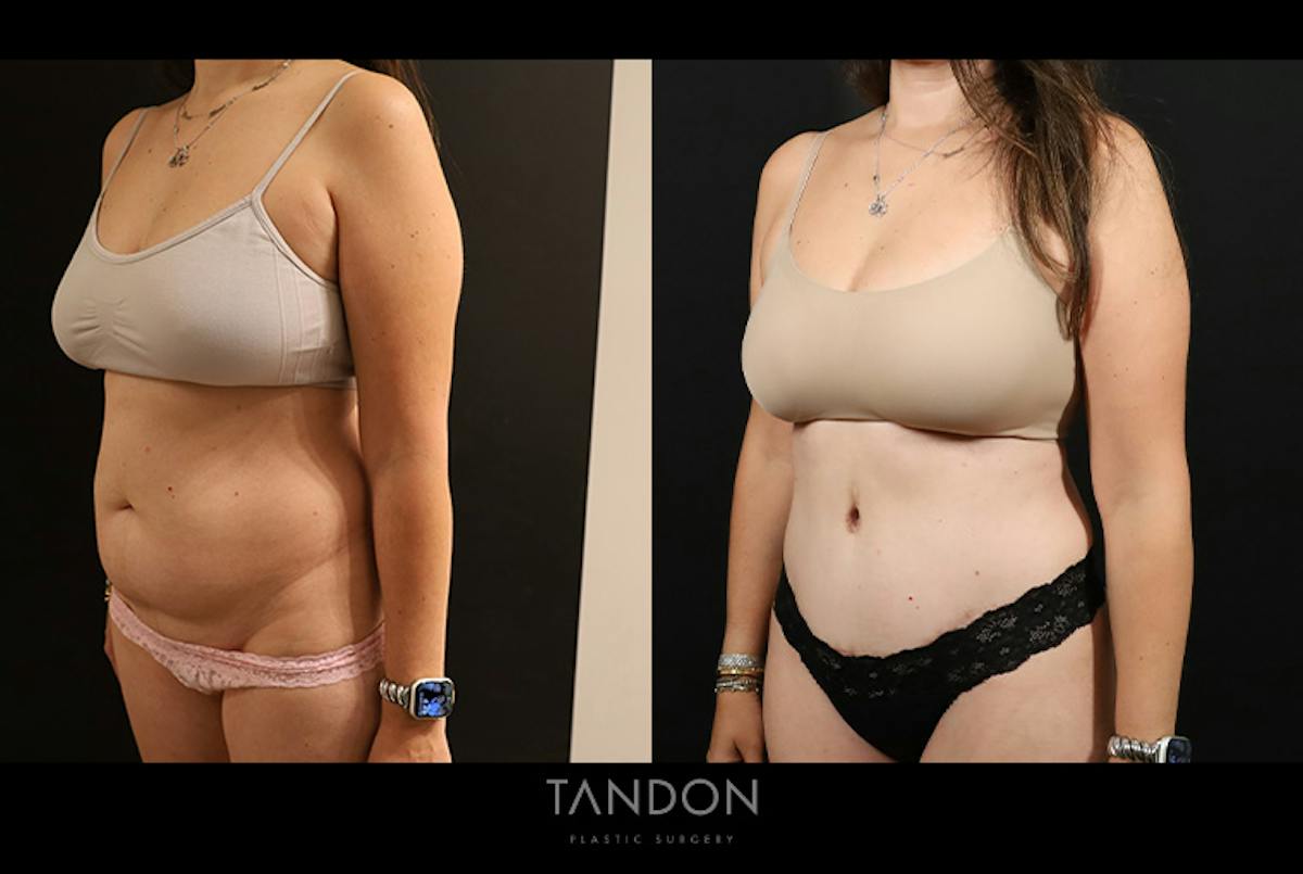 Liposuction and Fat Transfer Before & After Gallery - Patient 310712 - Image 4