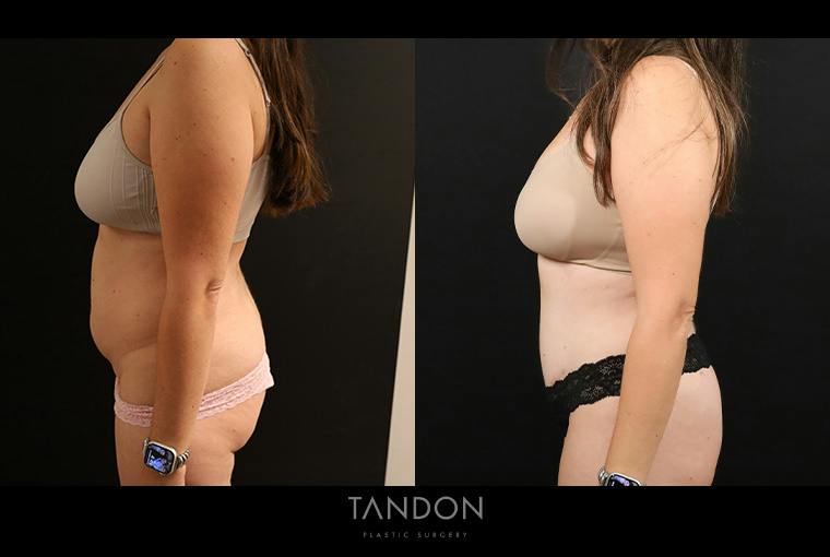 Liposuction and Fat Transfer Before & After Gallery - Patient 310712 - Image 5