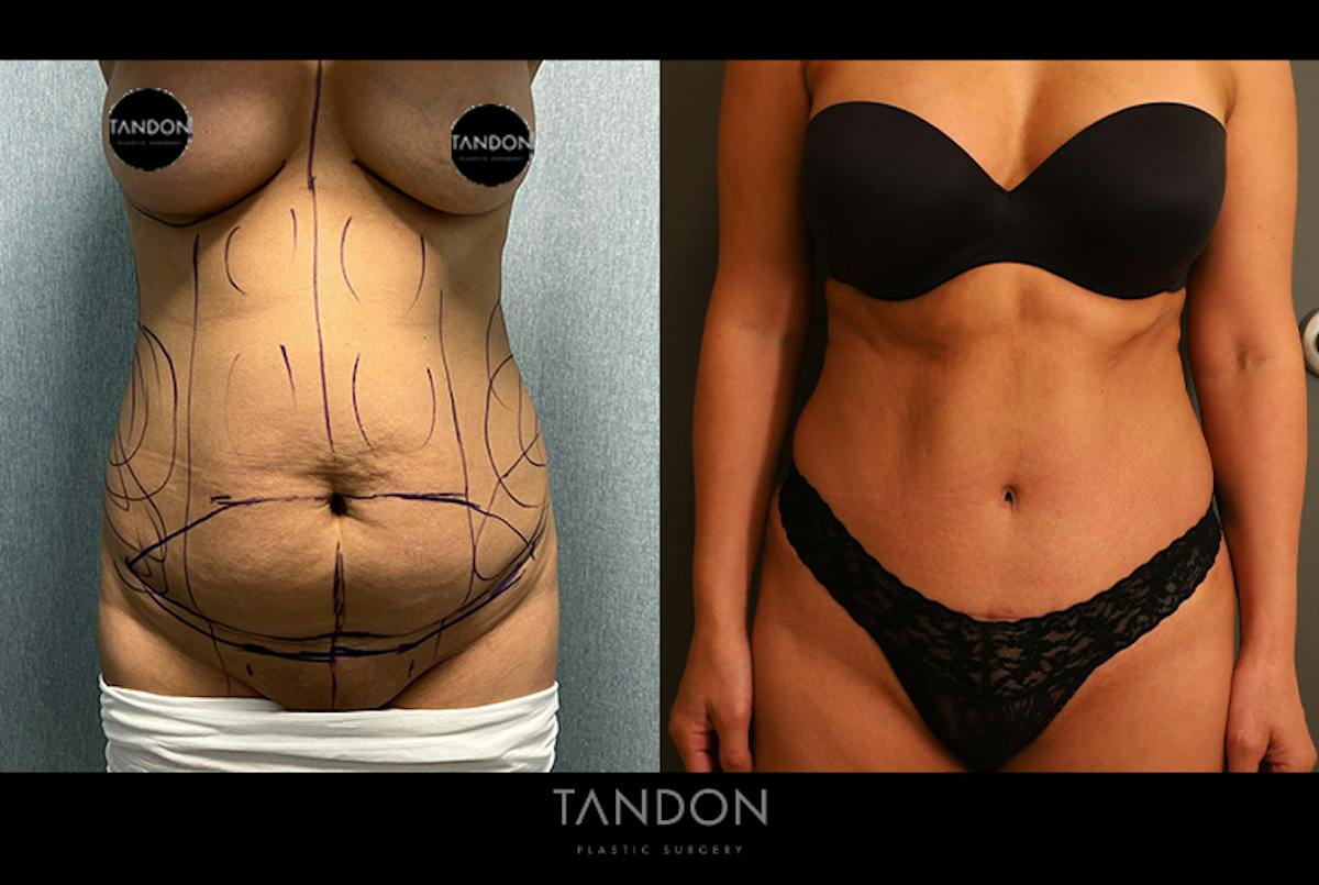 Abdominoplasty (Tummy Tuck) Before & After Gallery - Patient 367304 - Image 1