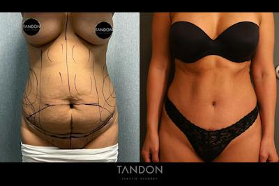 Abdominoplasty (Tummy Tuck) Before & After Gallery - Patient 367304 - Image 1