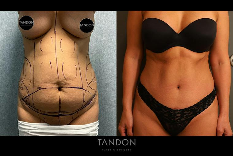 Abdominoplasty (Tummy Tuck) Before & After Gallery - Patient 367304 - Image 1