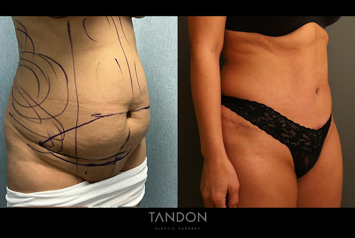Abdominoplasty (Tummy Tuck) Before & After Gallery - Patient 367304 - Image 2