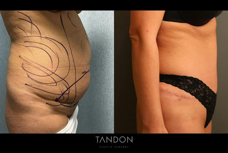 Abdominoplasty (Tummy Tuck) Before & After Gallery - Patient 367304 - Image 3