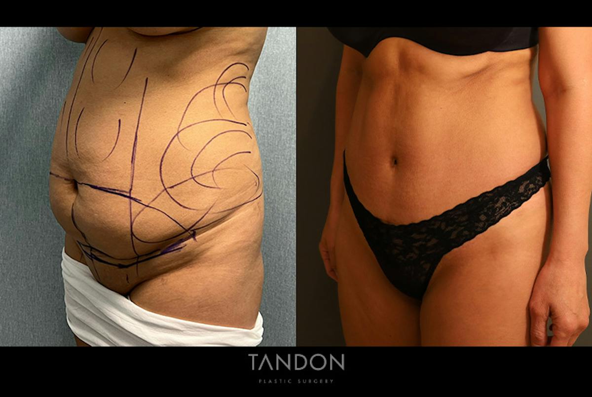 Abdominoplasty (Tummy Tuck) Before & After Gallery - Patient 367304 - Image 5