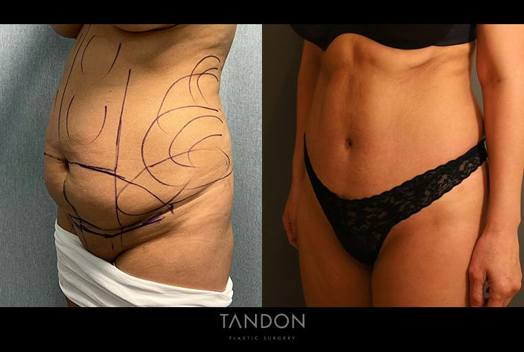 Abdominoplasty (Tummy Tuck) Before & After Gallery - Patient 367304 - Image 5