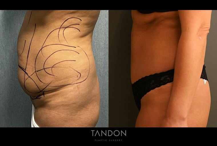Abdominoplasty (Tummy Tuck) Before & After Gallery - Patient 367304 - Image 4