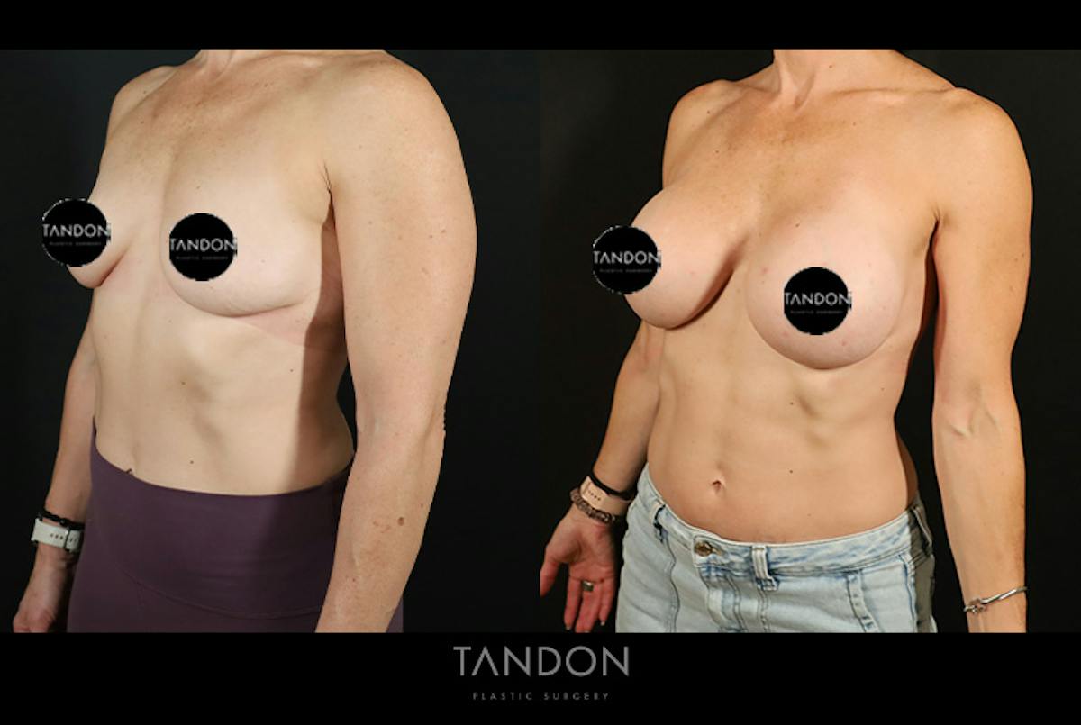 Preservé by Motiva Breast Augmentation Before & After Gallery - Patient 287179 - Image 4