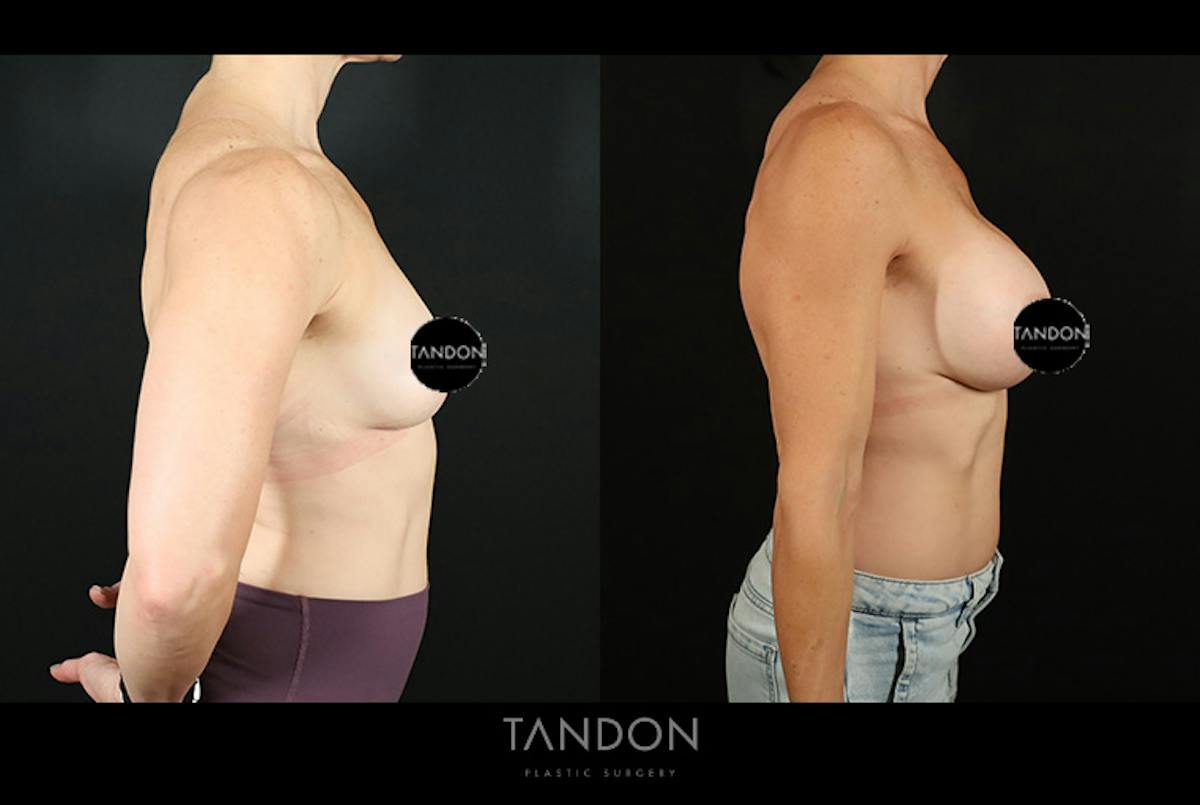 Preservé by Motiva Breast Augmentation Before & After Gallery - Patient 287179 - Image 3