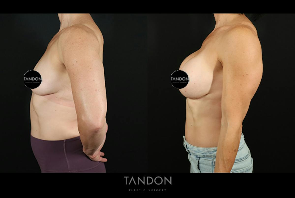 Preservé by Motiva Breast Augmentation Before & After Gallery - Patient 287179 - Image 5