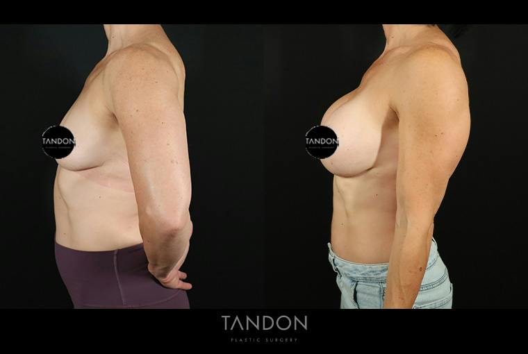 Preservé by Motiva Breast Augmentation Before & After Gallery - Patient 287179 - Image 5