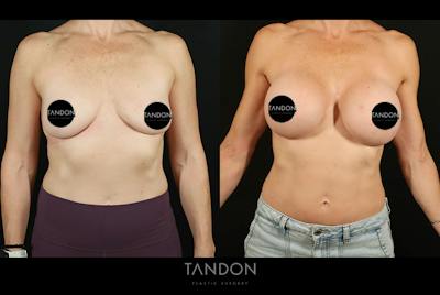 Preservé by Motiva Breast Augmentation Before & After Gallery - Patient 287179 - Image 1