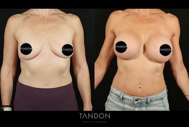 Preservé by Motiva Breast Augmentation Before & After Gallery - Patient 287179 - Image 1
