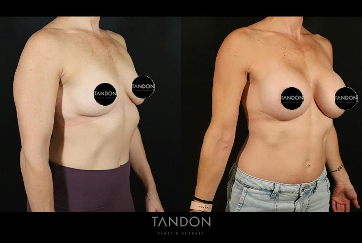 Preservé by Motiva Breast Augmentation Before & After Gallery - Patient 287179 - Image 2