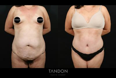 Liposuction and Fat Transfer Before & After Gallery - Patient 179774 - Image 1