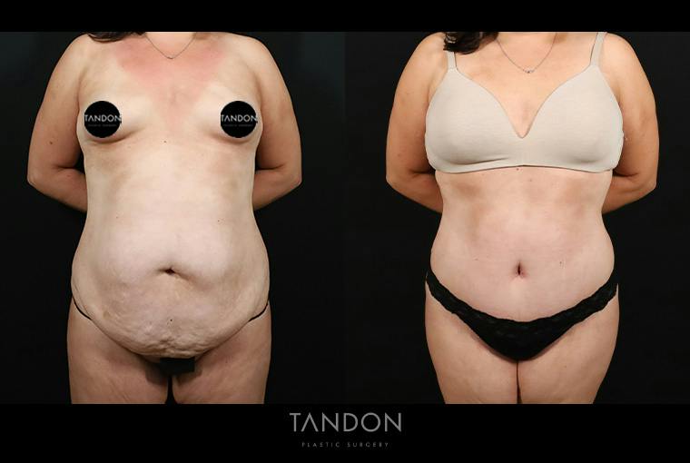 Liposuction and Fat Transfer Before & After Gallery - Patient 179774 - Image 1