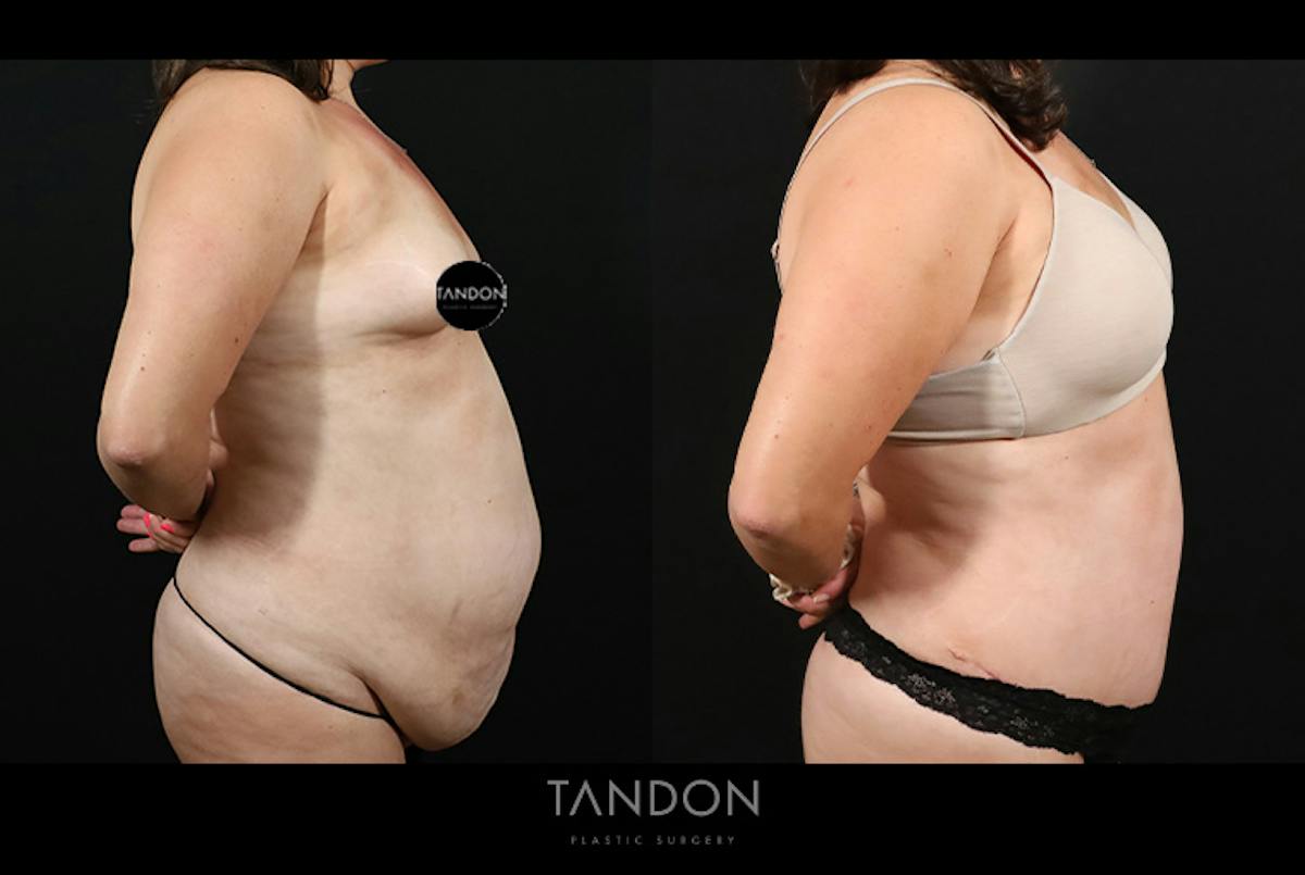 Liposuction and Fat Transfer Before & After Gallery - Patient 179774 - Image 3
