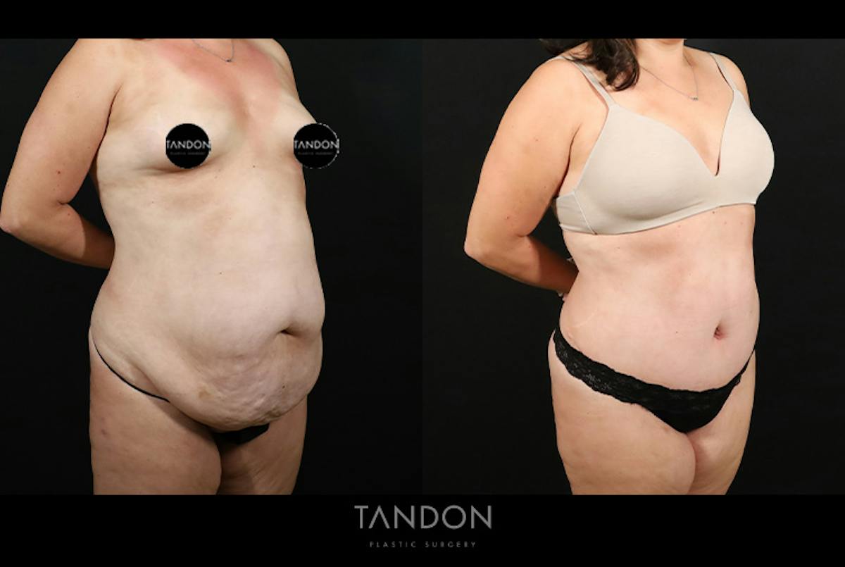 Liposuction and Fat Transfer Before & After Gallery - Patient 179774 - Image 2