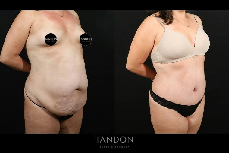 Liposuction and Fat Transfer Before & After Gallery - Patient 179774 - Image 2