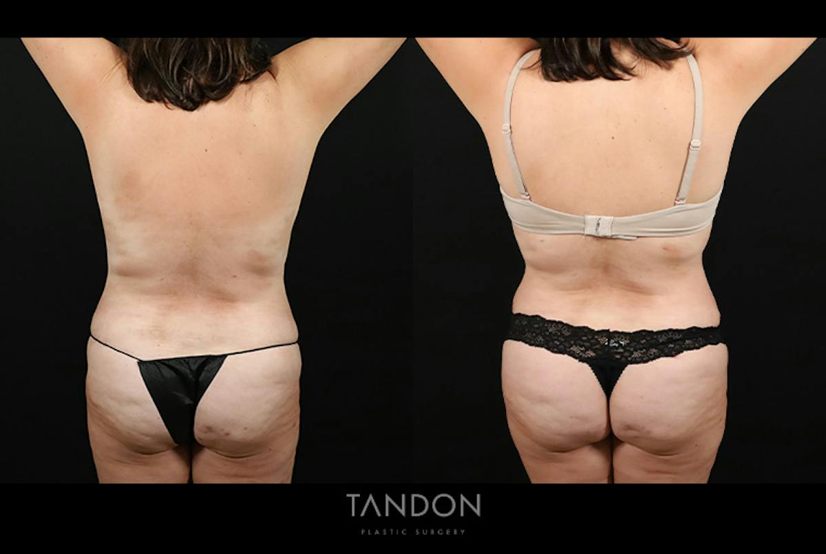 Liposuction and Fat Transfer Before & After Gallery - Patient 179774 - Image 4