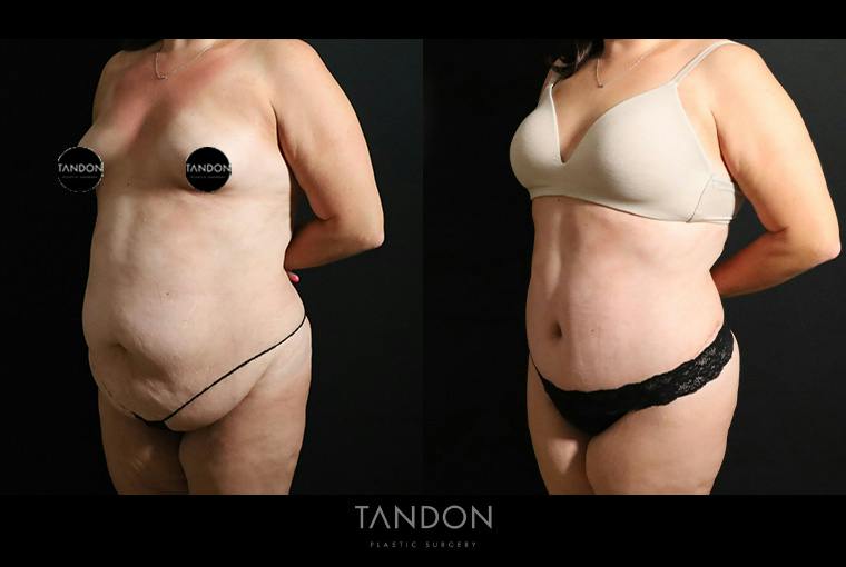 Liposuction and Fat Transfer Before & After Gallery - Patient 179774 - Image 5