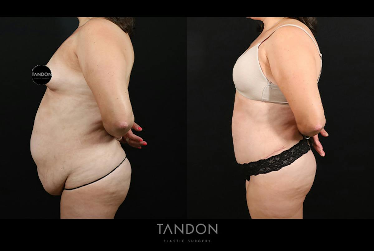 Liposuction and Fat Transfer Before & After Gallery - Patient 179774 - Image 6