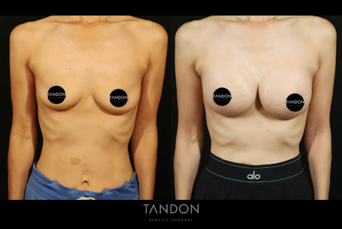 Breast Augmentation Before & After Gallery - Patient 108444 - Image 1