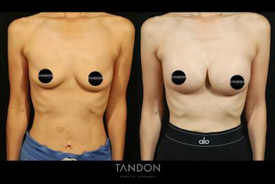 Breast Augmentation Before & After Gallery - Patient 108444 - Image 1