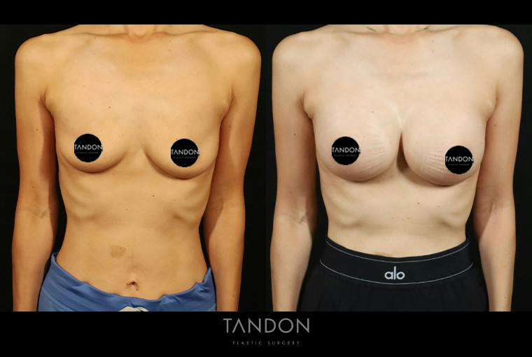 Breast Augmentation Before & After Gallery - Patient 108444 - Image 1
