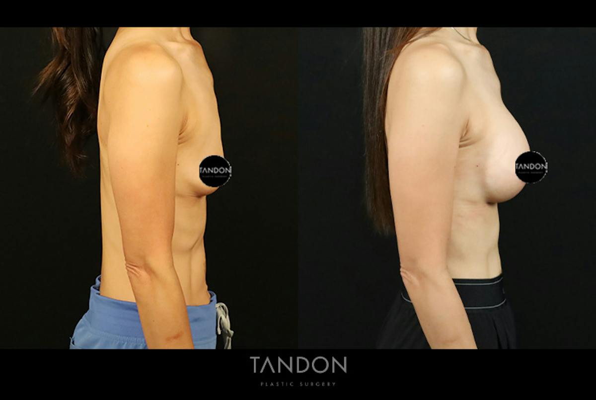 Breast Augmentation Before & After Gallery - Patient 108444 - Image 3
