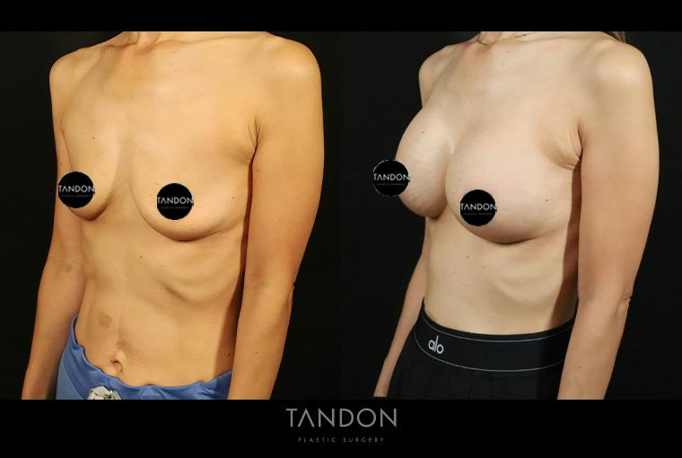 Breast Augmentation Before & After Gallery - Patient 108444 - Image 4