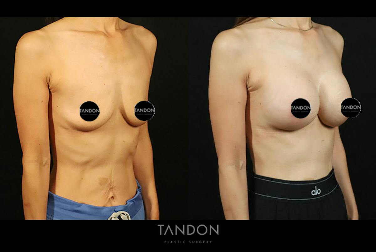 Breast Augmentation Before & After Gallery - Patient 108444 - Image 2