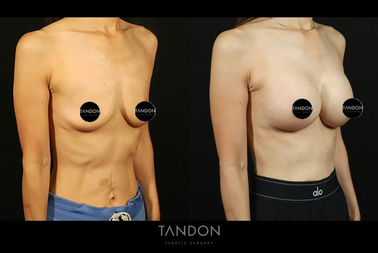 Breast Augmentation Before & After Gallery - Patient 108444 - Image 2