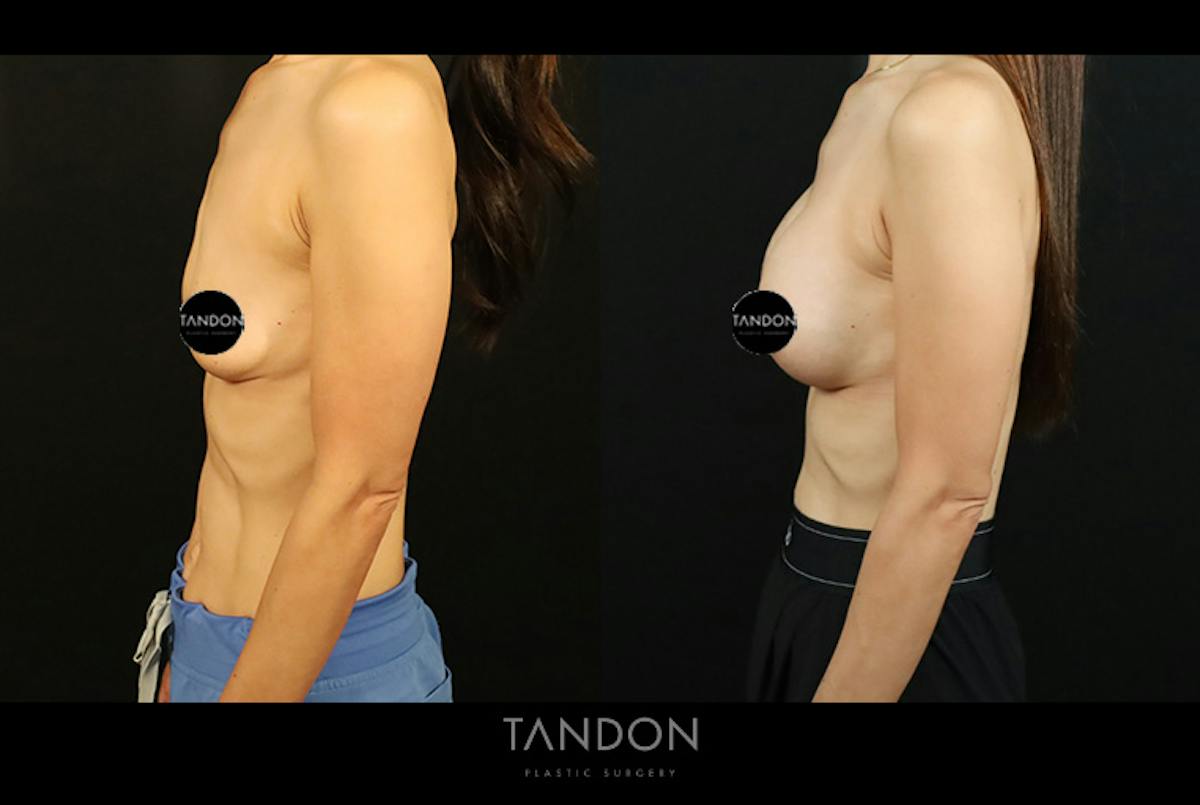 Breast Augmentation Before & After Gallery - Patient 108444 - Image 5