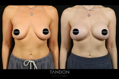 Preservé by Motiva Breast Augmentation Before & After Gallery - Patient 416466 - Image 1