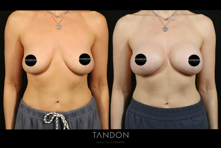 Preservé by Motiva Breast Augmentation Before & After Gallery - Patient 416466 - Image 1
