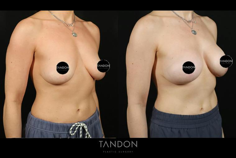 Preservé by Motiva Breast Augmentation Before & After Gallery - Patient 416466 - Image 2