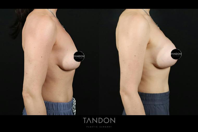 Preservé by Motiva Breast Augmentation Before & After Gallery - Patient 416466 - Image 3