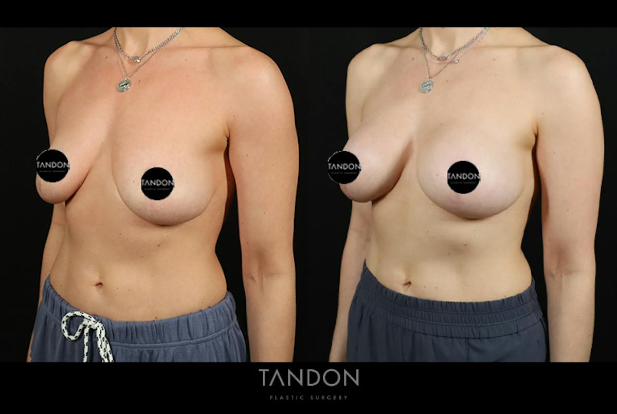Preservé by Motiva Breast Augmentation Before & After Gallery - Patient 416466 - Image 4