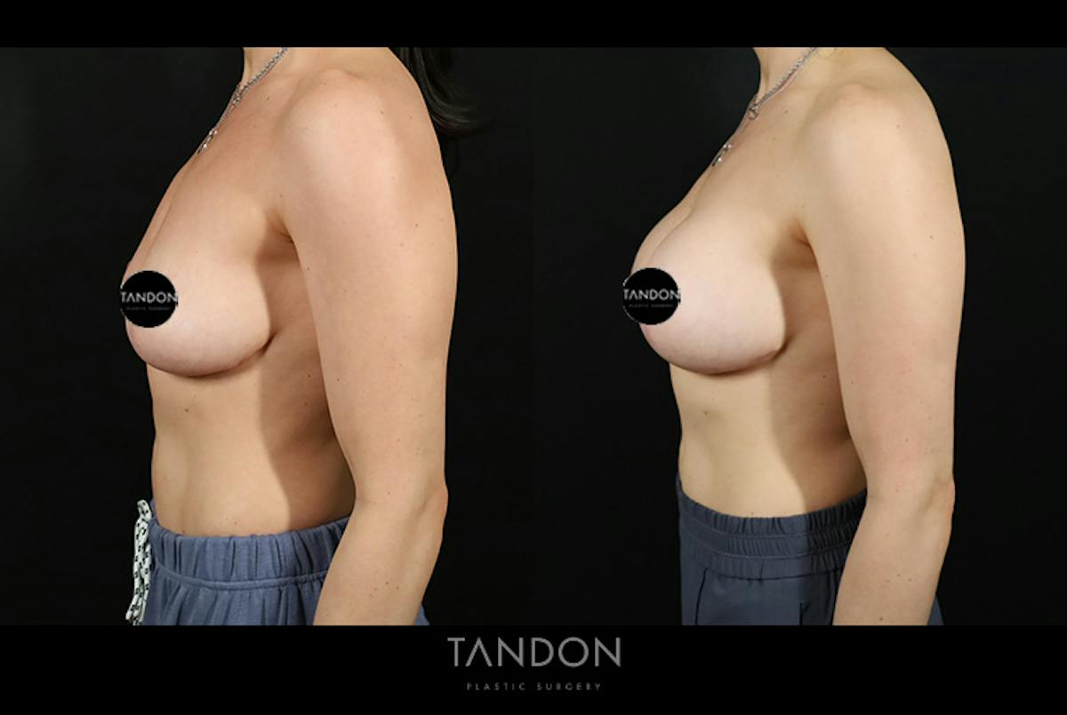 Preservé by Motiva Breast Augmentation Before & After Gallery - Patient 416466 - Image 5