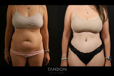 Liposuction and Fat Transfer Before & After Gallery - Patient 310712 - Image 1