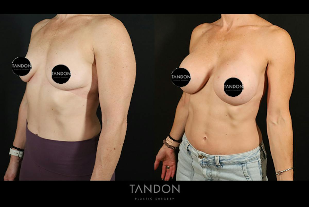 Breast Augmentation Before & After Gallery - Patient 559008 - Image 4