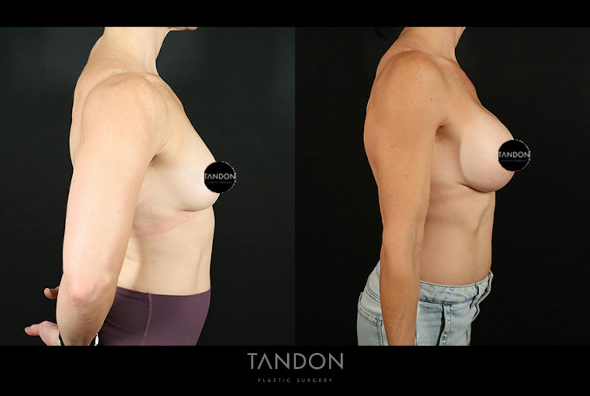 Breast Augmentation Before & After Gallery - Patient 559008 - Image 3
